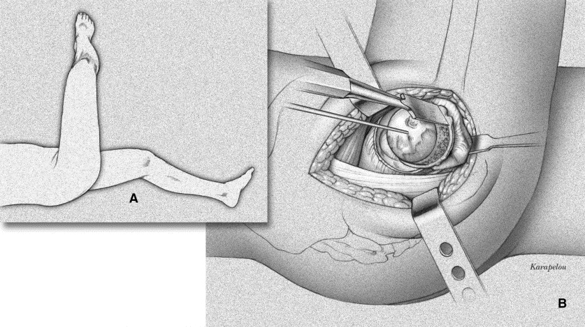 Retinacular Arteries Of Hip